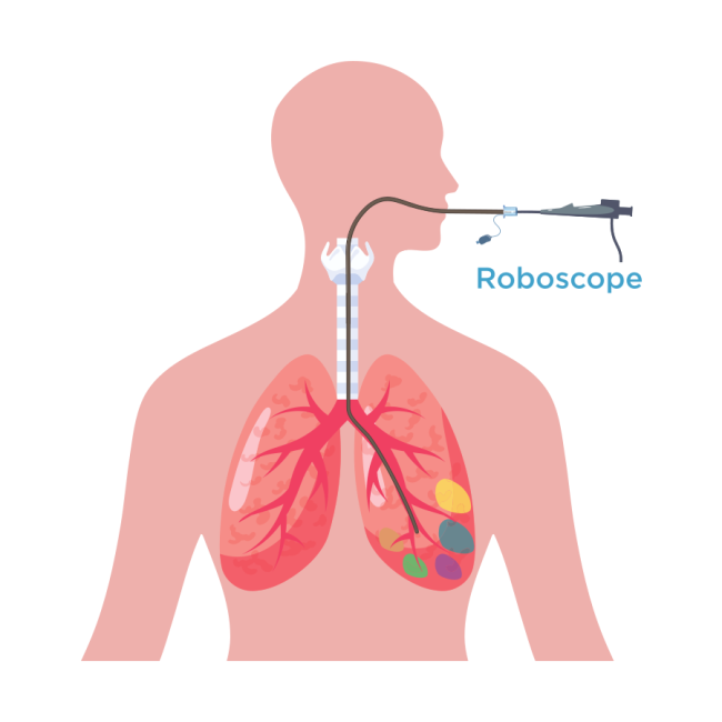 Robotic bronchoscopy